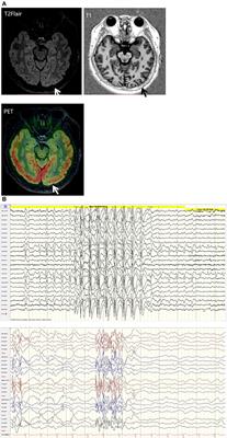 Case Report: Late-Onset Lennox-Gastaut Syndrome Treated With Stereotactic Electroencephalography-Guided Radiofrequency Thermocoagulation Before Craniotomy